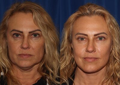 Front View Multilift before and after photo by Dr. Wick featured x