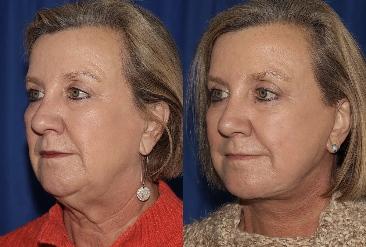 Left Oblique View Multilift before and after photo by Dr. Wick