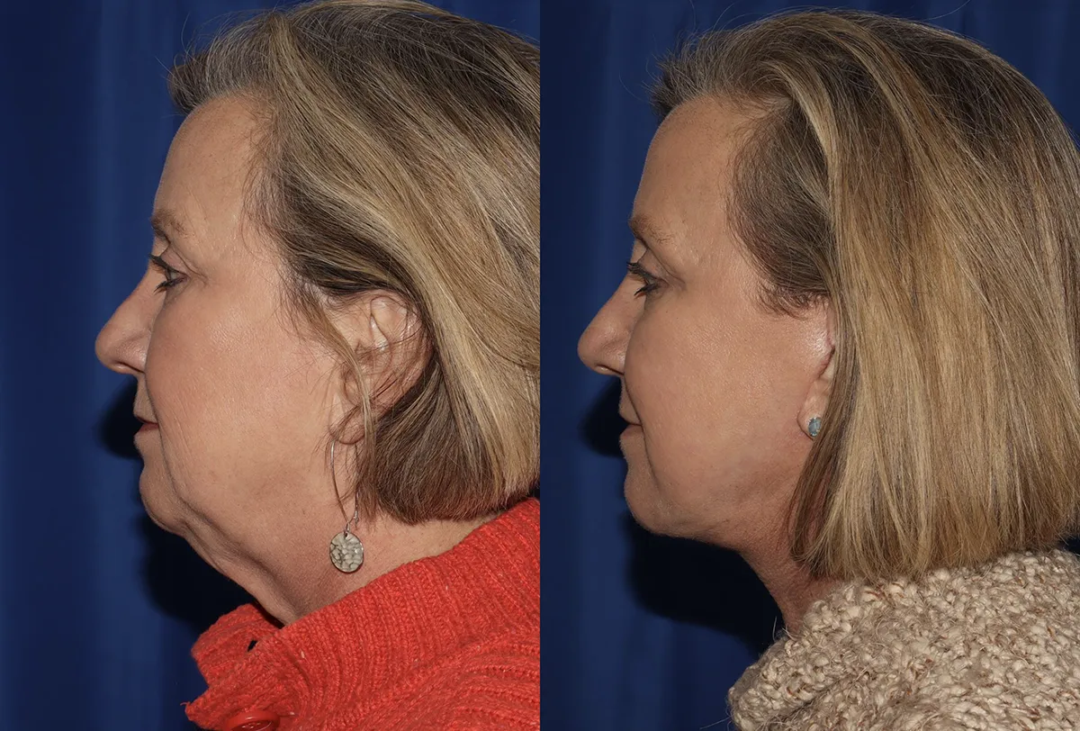 Left Side View Multilift before and after photo by Dr. Wick
