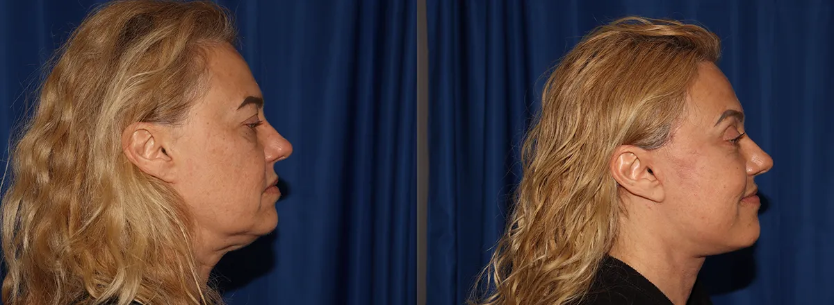 Right Side View Multilift before and after photo by Dr. Wick